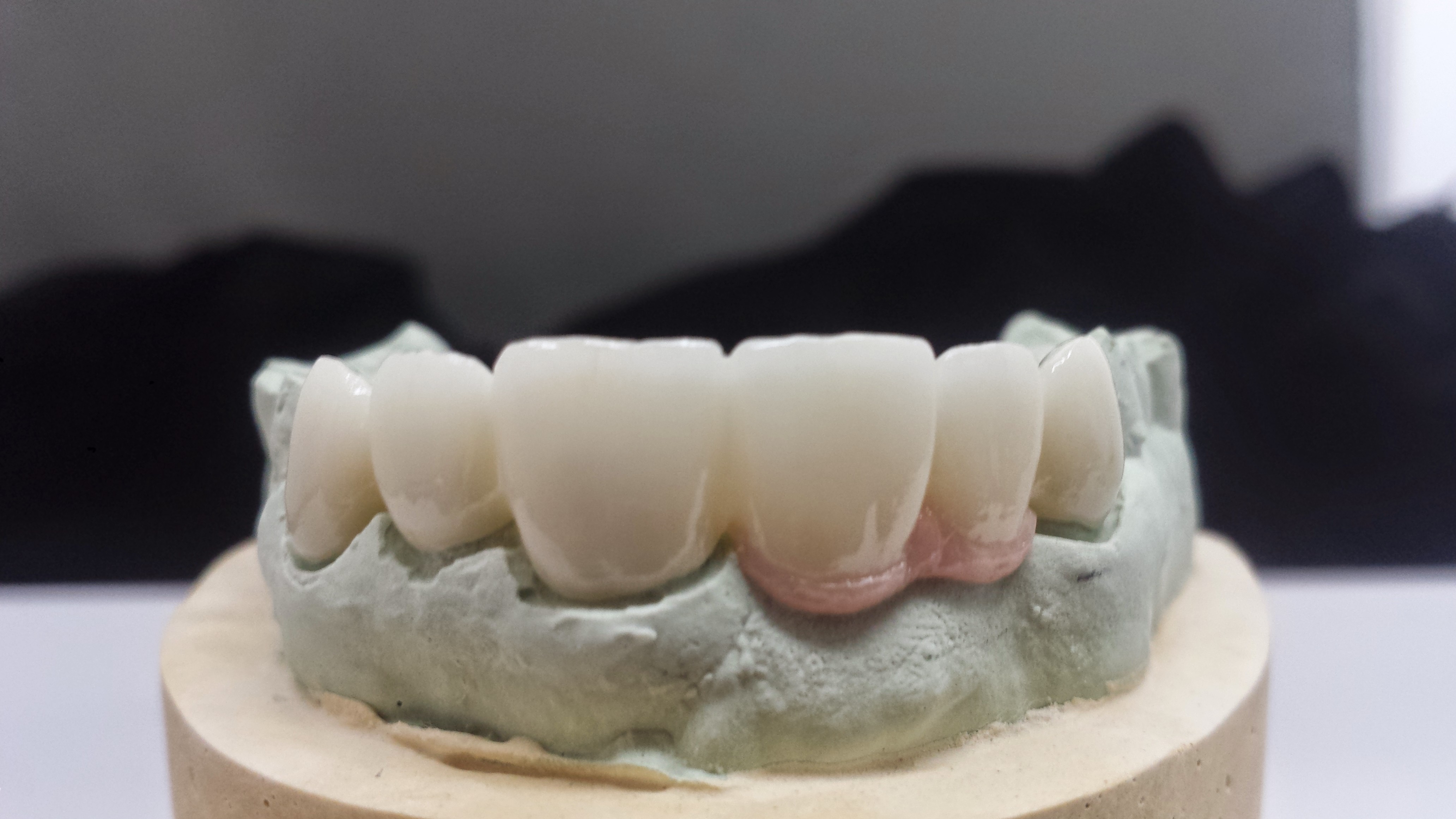 6 unit PFZ w/ pink porcelain