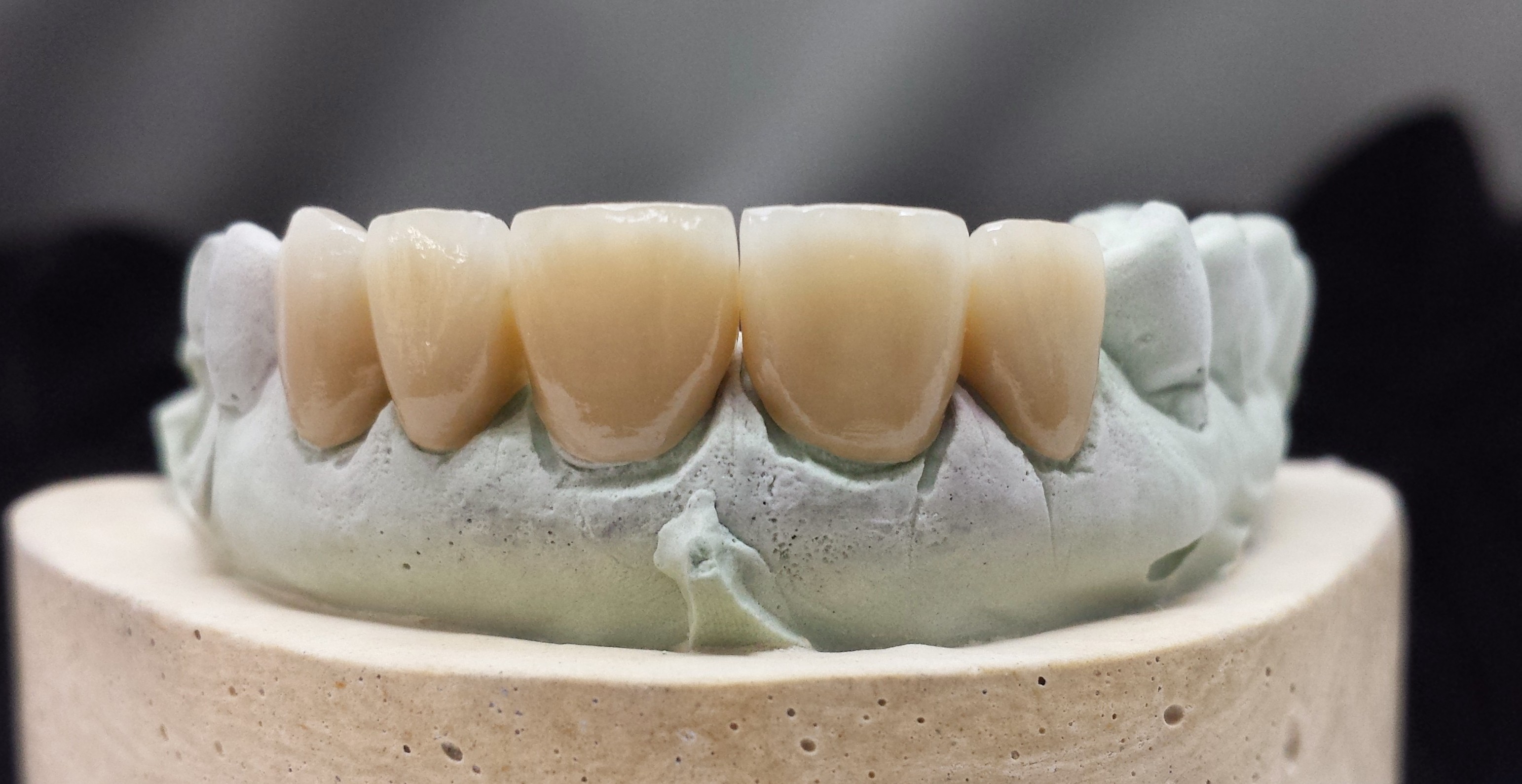 5 unit Porcelain Fused to Zirconia