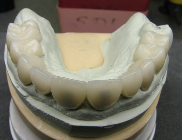 10 Unit Upper IPS e.max® Reconstruction