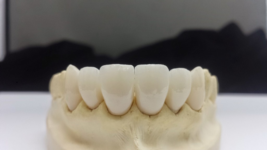 6 Unit IPS e.max® Anterior Aesthetics