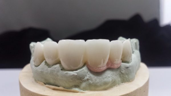 6 Unit PFZ w/ Pink Tissue Porcelain